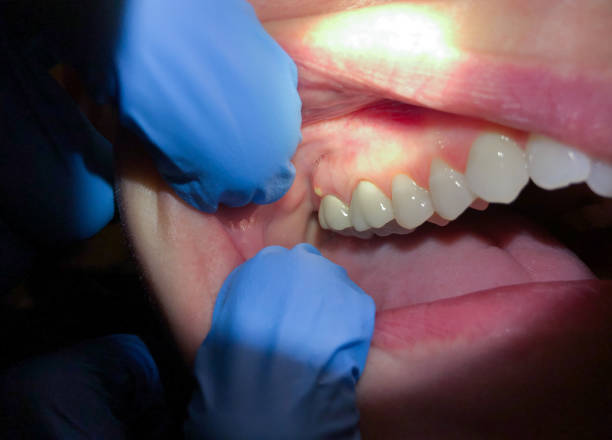 Best Emergency Dentist for Lost Fillings or Crowns in Union, MS